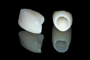 Технология Procera в протезировании зубов