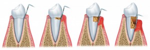 Виды гингивита в стоматологии