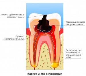 Глубокий кариес зубов и его лечение