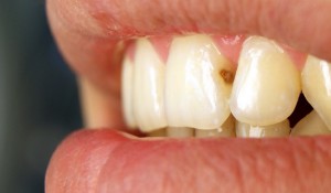 Кариес на передних зубах и его лечение