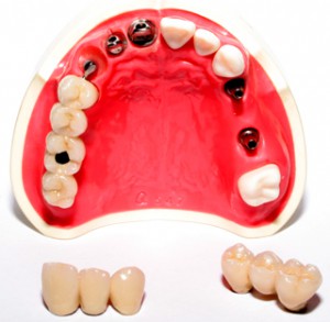Протезирование зубов коронками