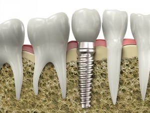 Внимание! Список противопоказаний для имплантации зубов