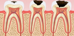Какие причины разрушения зубов?