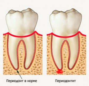 Что такое периодонтит?