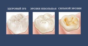 Семь мифов об эрозии эмали зубов