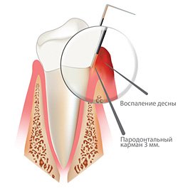 Что такое гингивит и как лечить?
