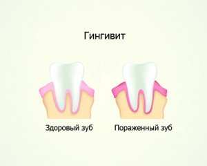 Что такое гингивит и как его вылечить?