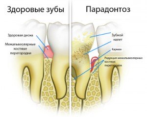 Лечение пародонтоза