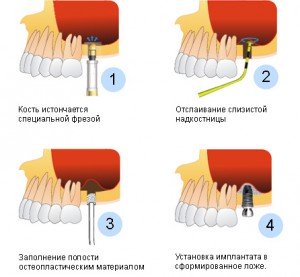 Синус-лифтинг