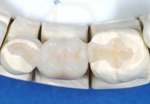 Адгезивное протезирование зубов без обточки