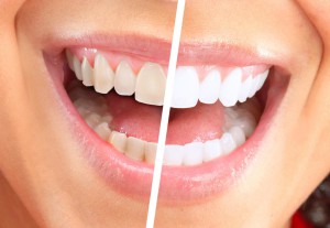 Как правильно и безопасно отбелить зубы дома?
