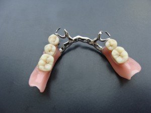 Минусы и плюсы бюгельных конструкций