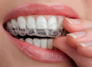 Какие бывают каппы для отбеливания зубов?