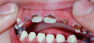 Лечение кариеса молочных зубов в раннем возрасте