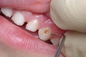 Основные пункты профилактики кариеса молочных зубов