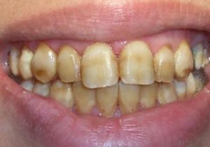 Флюороз зубов - симптомы и лечение