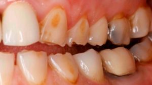 Эрозия зубов и как ее предотвратить?