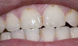 Чем опасна эрозия зубов?
