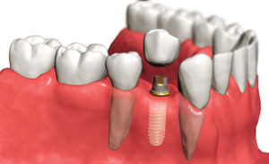 Где можно сделать имплантацию зубов?