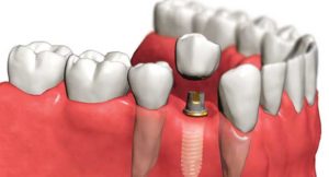 Как выбрать зубной имплант?
