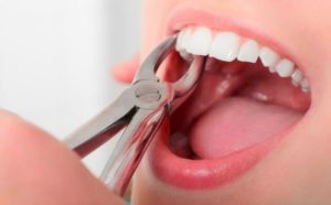 В каких случаях нельзя оставить зуб?