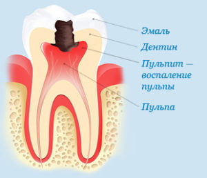 Лечение пульпита зубов в стоматологии