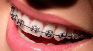 Брекеты - украшения для зубов