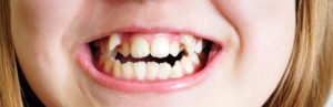 Что делать если у ребенка неровные зубы?