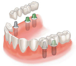 Ортопедия и протезирование зубов